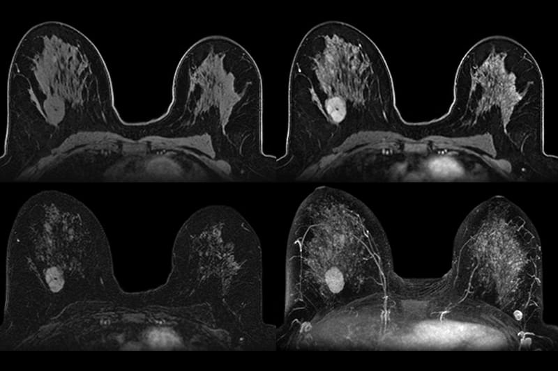 Photo of breasts scanned with AB-MRI