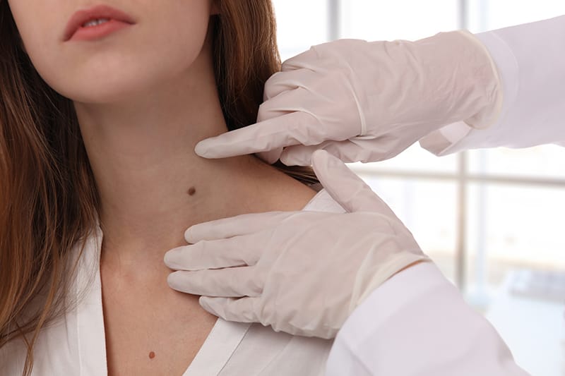 Woman getting her mole inspected by a doctor