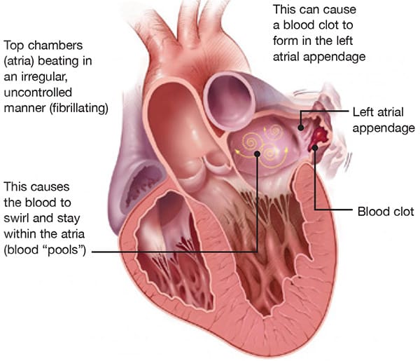 Diagram of a heart with atrial fibrillation