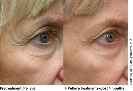 Pelleve Eye Treatments