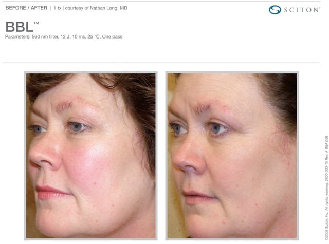 Phototherapy Face Before and After