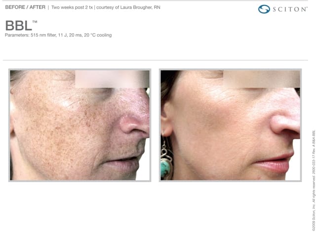 Phototherapy Freckles Before and After