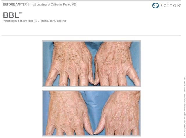 Phototherapy Hands Before and After