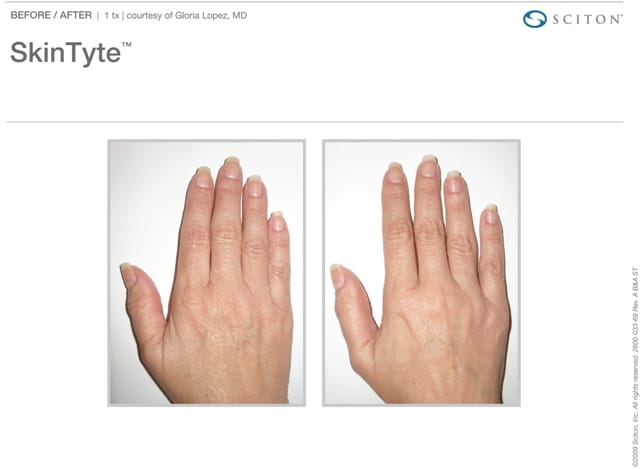 SkinTyte Hand