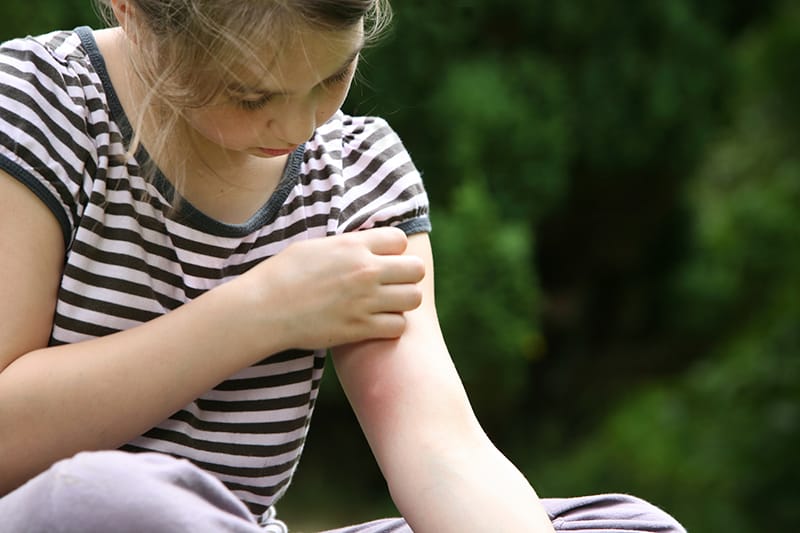 Child with bug bit on arm