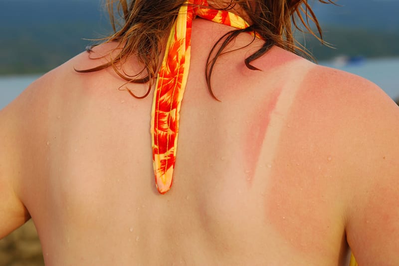 Woman with a sunburn