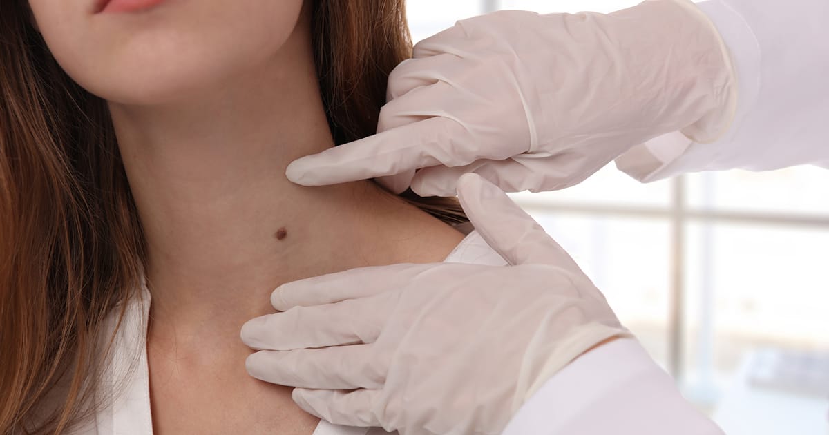 Just a Mole? Or Is It Skin Cancer? | The Iowa Clinic