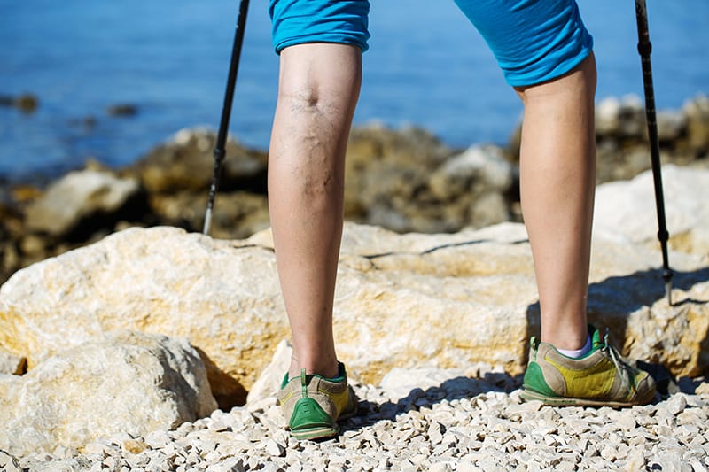 Legs with varicose veins standing