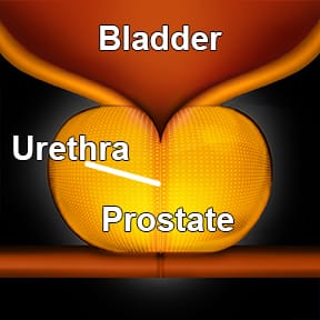 Image of an enlarged prostate