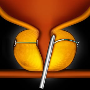 Image of UroLift<sup>®</sup> implant being placed on one top of both sides of prostate