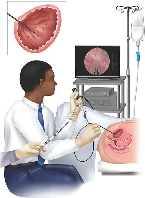 Diagram of a provider injecting Botox to improve bladder control