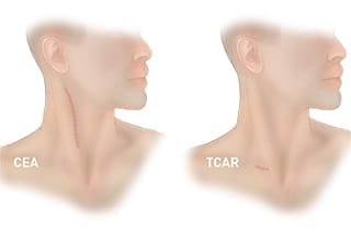 Illustration of CEA scar vs TCAR scar
