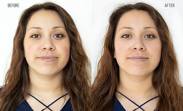 Hydrafacial - Before and After - Redness