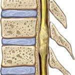 Spinal Cord / Root Tumors