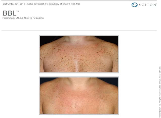 Phototherapy Chest Before and After