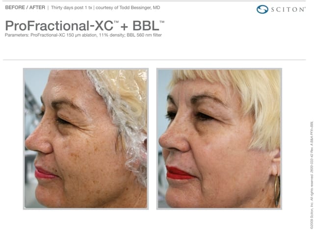 Image result for sciton profractional before and after