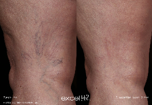 Spider veins before and after