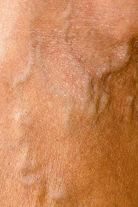 Photo of varicose veins